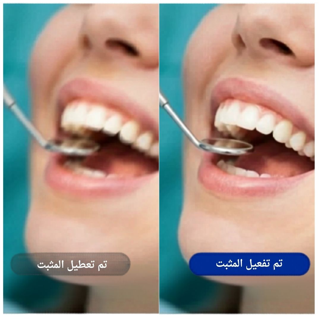مقارنة تثبيت الصورة: إيقاف مقابل تشغيل — تسجيل أسنان أكثر وضوحًا